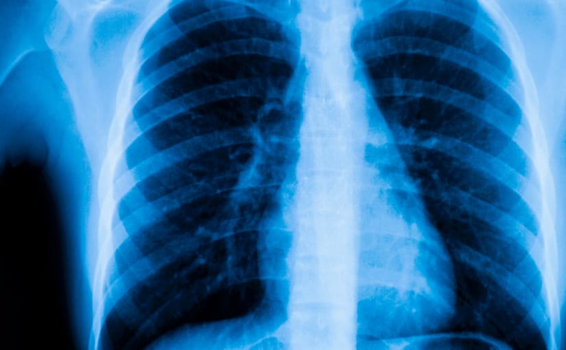 X ray of chest cavity